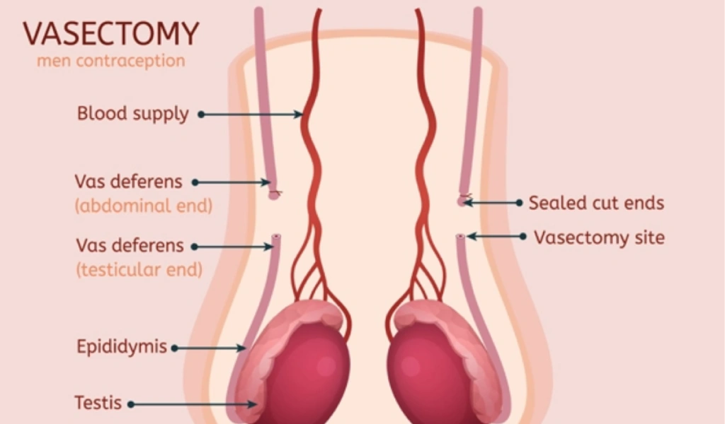 How can a woman become pregnant after a vasectomy? 